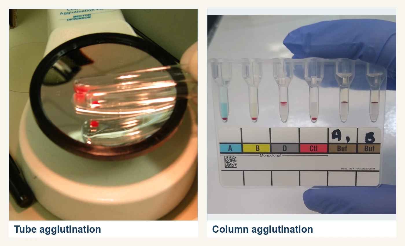 Two real blood-bank endpoint photographs show tube reactions being read through an agglutination viewer and a gel card with positive red-cell bands retained in columns and negative red-cell pellets at the bottom.