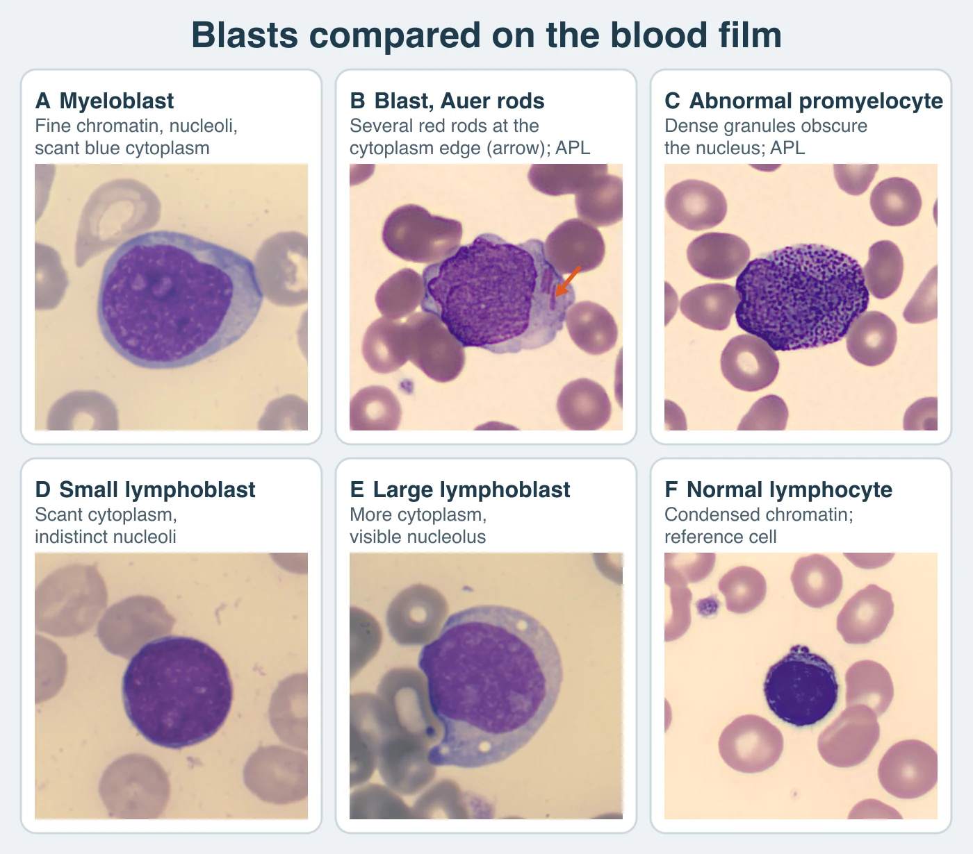 Six Romanowsky-stained single-cell fields. A myeloblast with fine chromatin, two nucleoli, and a thin rim of blue cytoplasm. A blast from acute promyelocytic leukemia with several red rods bundled at one edge of the cytoplasm, marked by an arrow. An abnormal promyelocyte whose dense purple granules cover the nucleus. A small lymphoblast with a round nucleus and almost no cytoplasm. A larger lymphoblast with more cytoplasm and a visible nucleolus. A normal small lymphocyte with dark condensed chromatin.