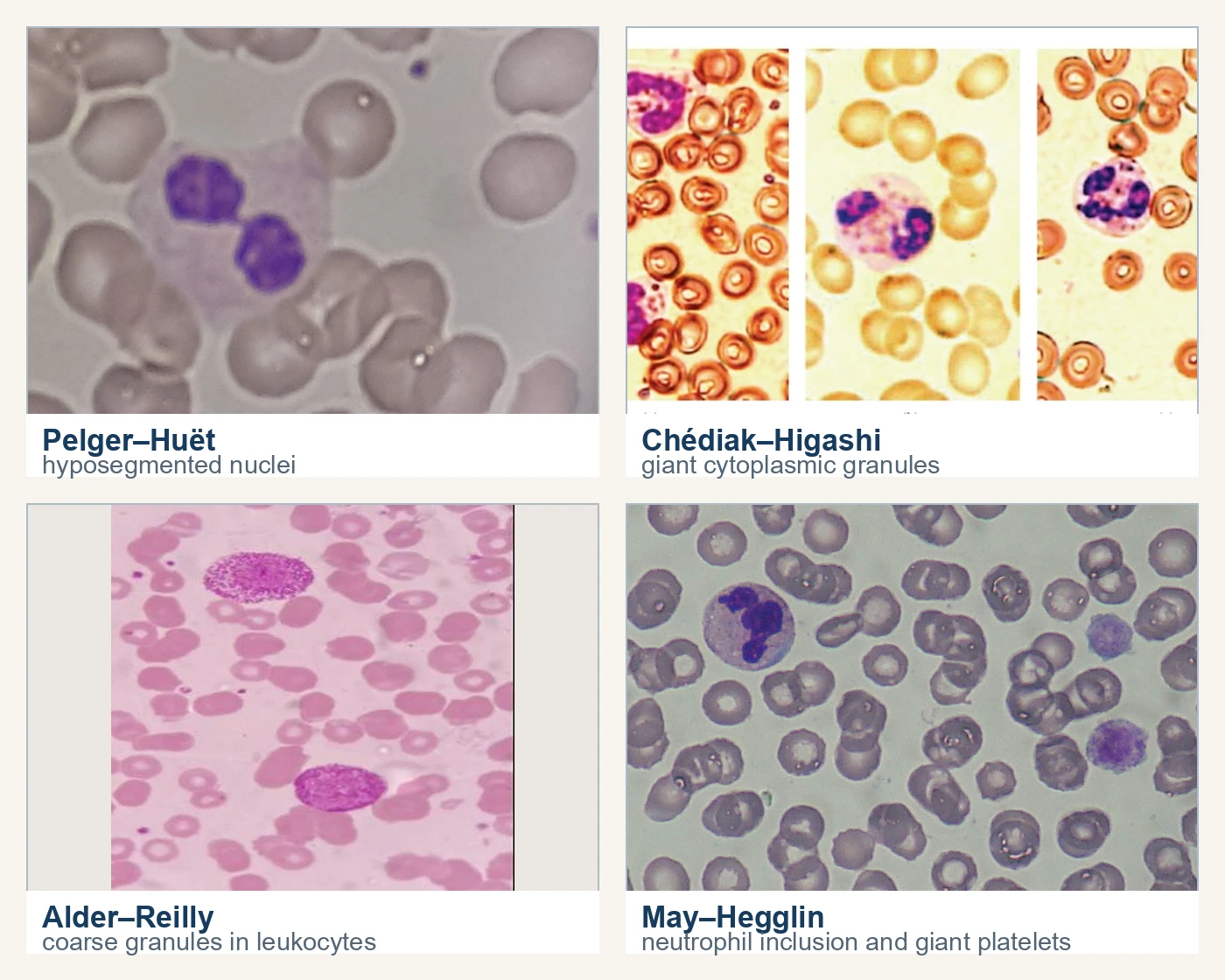 Four blood-film photographs show hyposegmented Pelger-Huet neutrophils, Chediak-Higashi neutrophils with giant cytoplasmic granules, Alder-Reilly leukocytes with coarse granules, and a May-Hegglin neutrophil with a pale inclusion beside giant platelets.