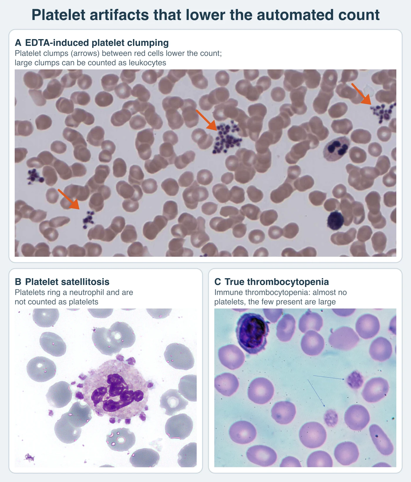 Three blood-film fields. In the first, several purple clusters of platelets lie between normal red cells, three of them marked with arrows, with one neutrophil and one lymphocyte nearby. In the second, a neutrophil is ringed by a rosette of platelets attached to its edge. In the third, a field of red cells contains only two platelets, both large, and a lymphocyte.