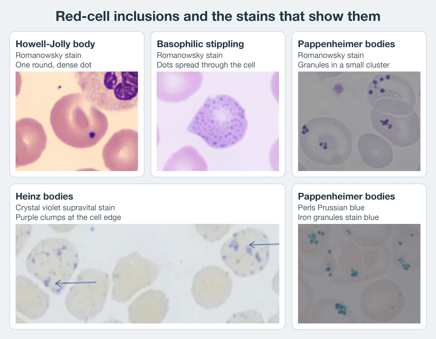 Five photographs of red cells. Three Romanowsky-stained fields: a red cell holding one round, dense, dark purple dot beside a neutrophil; a polychromatic red cell with fine purple dots spread evenly through it; red cells holding small clusters of dark purple granules. A crystal violet field shows pale red cells, two of them with purple clumps at the cell edge marked by arrows. A Perls Prussian blue field shows pale red cells holding clusters of blue-green granules.