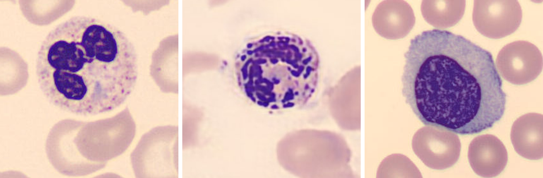 Three cropped peripheral blood-film images show a segmented neutrophil with a pale blue-gray Döhle body near the cell edge, a segmented neutrophil containing dark phagocytosed bacterial forms, and a large reactive lymphocyte with abundant gray-blue cytoplasm.