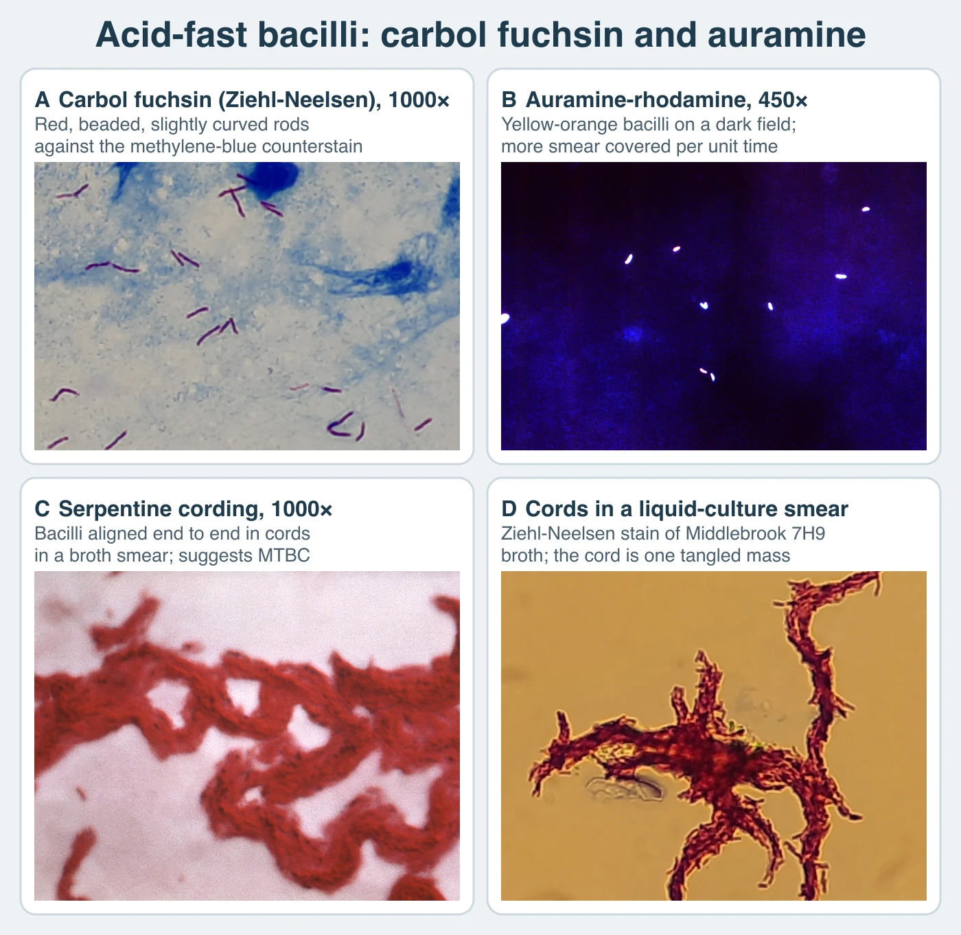 Four smear fields. Ziehl-Neelsen at 1000 times: about twenty thin red rods, some beaded and gently curved, scattered over a blue-stained sputum background with a few blue cell nuclei. Auramine-rhodamine at 450 times: nine small bright yellow-white rods glowing on a dark blue-black field. Serpentine cording at 1000 times: thick red rope-like strands of bacilli winding across a pale field. A liquid-culture smear: one branching tangle of red-stained cord on a yellow background.