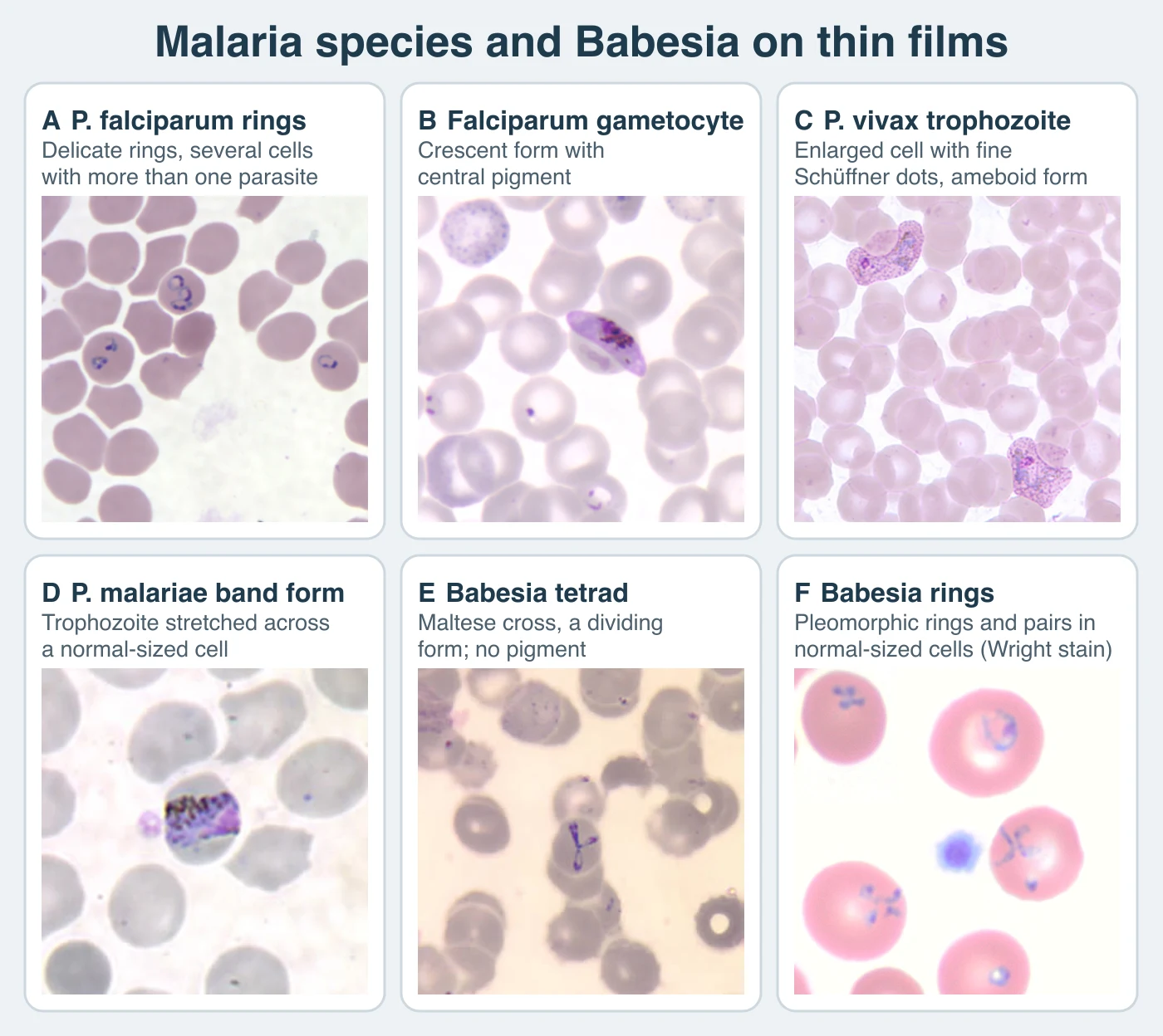 Six thin-film fields. P. falciparum: thin rings with small chromatin dots in normal-sized red cells, two cells containing more than one ring. A single crescent-shaped falciparum gametocyte with dark pigment along its middle. P. vivax: two enlarged red cells filled with fine stippling around irregular ameboid trophozoites. P. malariae: one parasite forming a straight band across a normal-sized red cell with dark pigment along it. Babesia: a cross-shaped tetrad of four small parasites inside one red cell. Babesia: rings of different sizes and shapes, some paired, in normal-sized red cells with no pigment and one extracellular form.