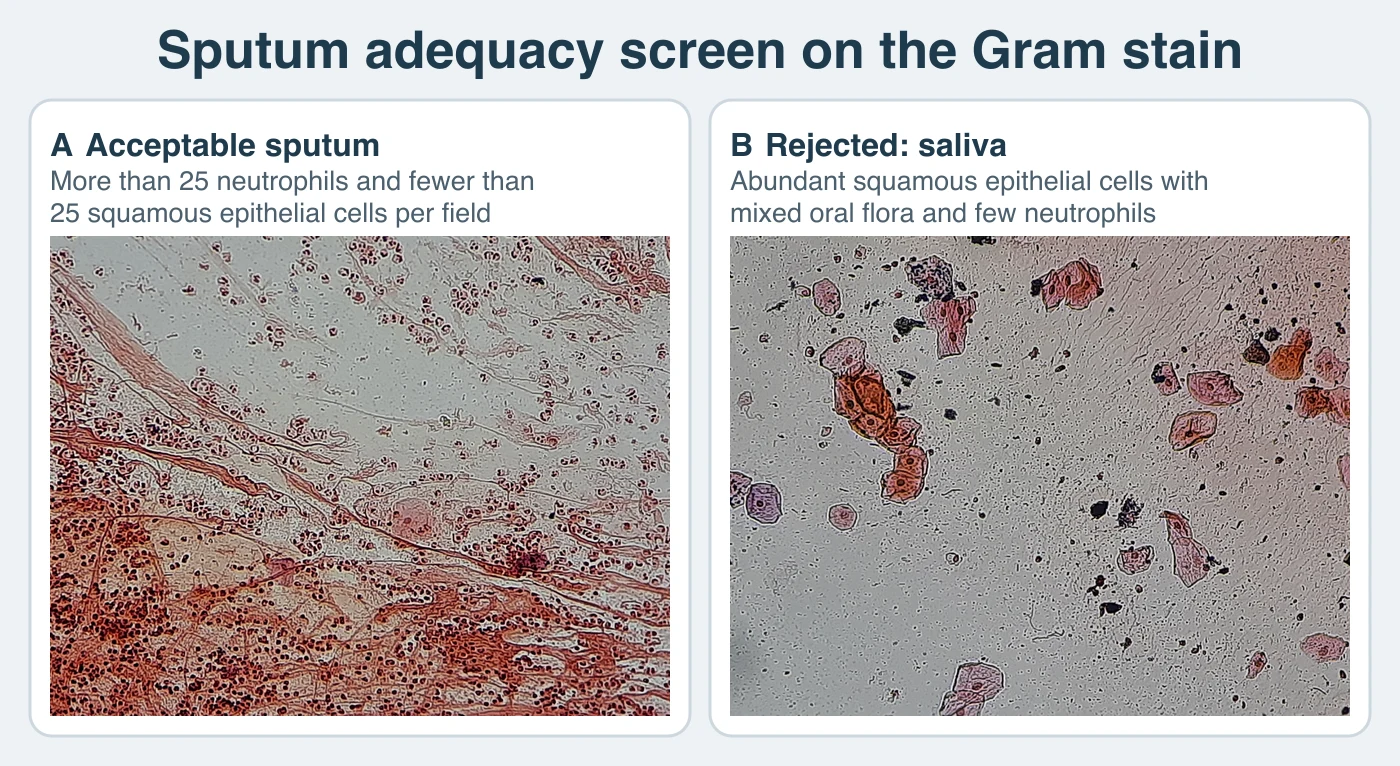 Two low-power Gram-stained fields side by side. The acceptable field is crowded with small dark neutrophil nuclei in pink mucus strands and contains one large squamous epithelial cell. The rejected field contains numerous large flat squamous epithelial cells with small nuclei, scattered dark clumps of bacteria and debris, and few neutrophils.