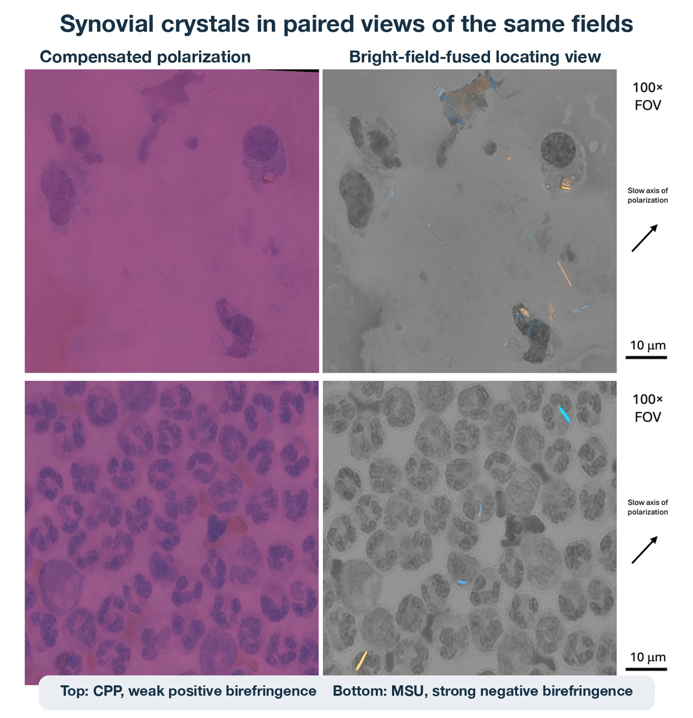 Two same-field rows compare synovial crystals. The top row shows calcium pyrophosphate crystals in a magenta compensated polarized view and a gray bright-field-fused locating view. The bottom row shows monosodium urate needles in the same two view types. External labels identify weak positive birefringence for calcium pyrophosphate and strong negative birefringence for monosodium urate.