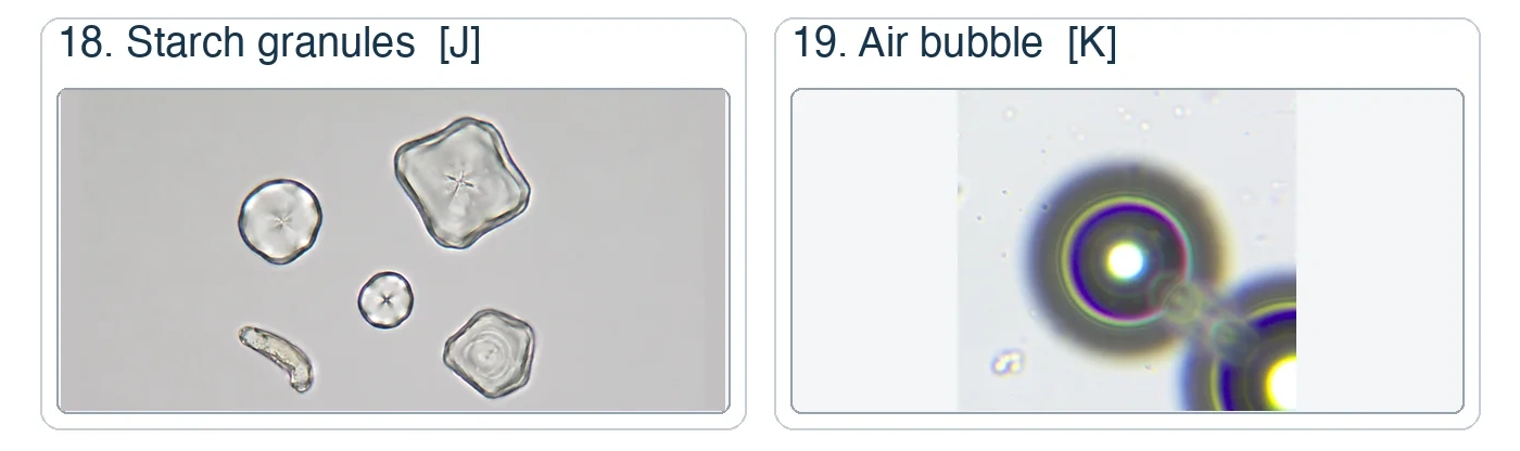 Two numbered urine sediment photomicrograph panels: starch granules and an air bubble.