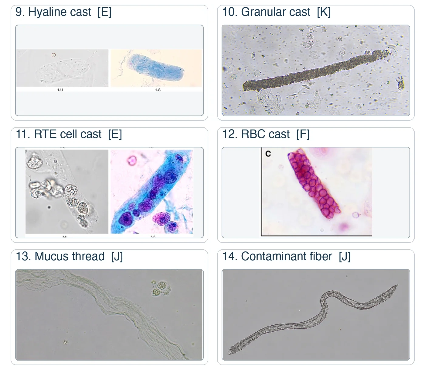 Six numbered urine sediment photomicrograph panels: hyaline cast, granular cast, renal tubular epithelial cell cast, RBC cast, mucus thread, and contaminant fiber.