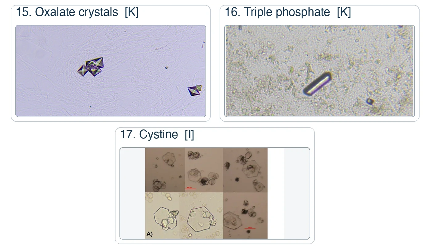 Three numbered urine sediment photomicrograph panels: oxalate crystals, triple phosphate crystal, and cystine crystals.