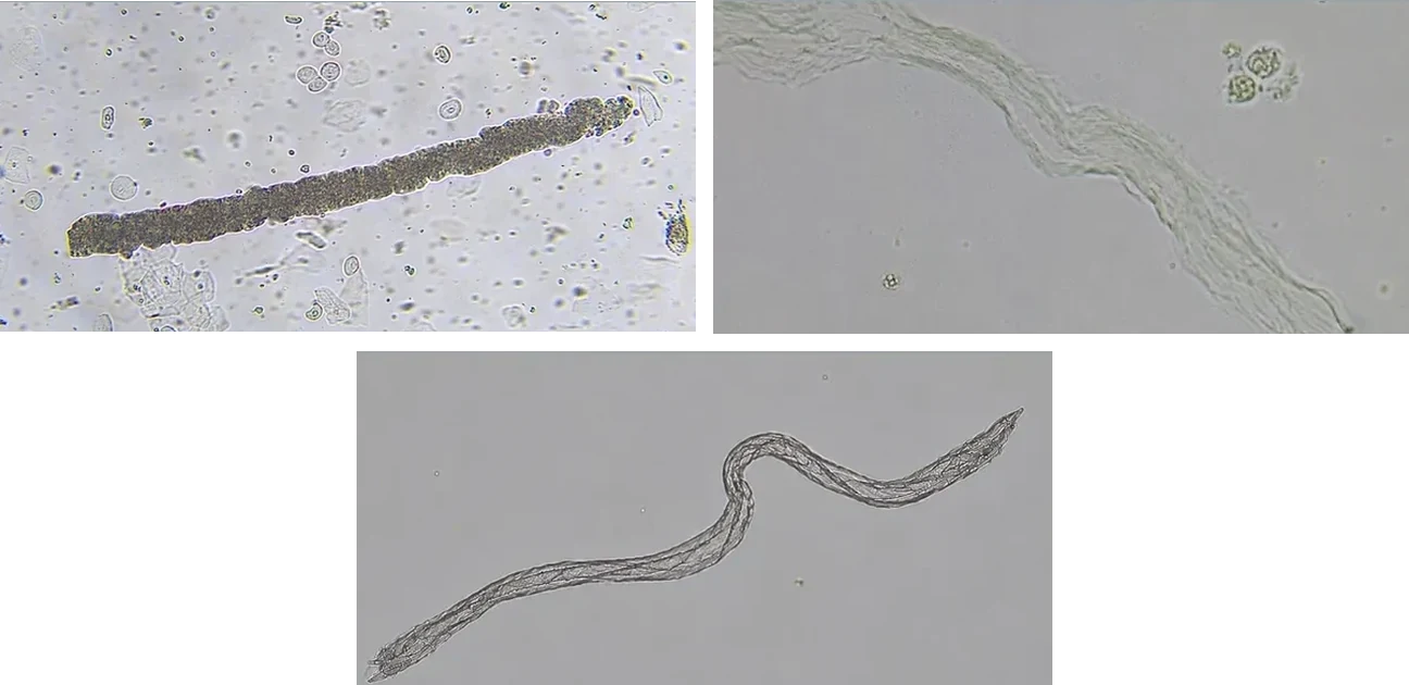 Three unlabeled urine sediment photomicrographs, two above and one below.