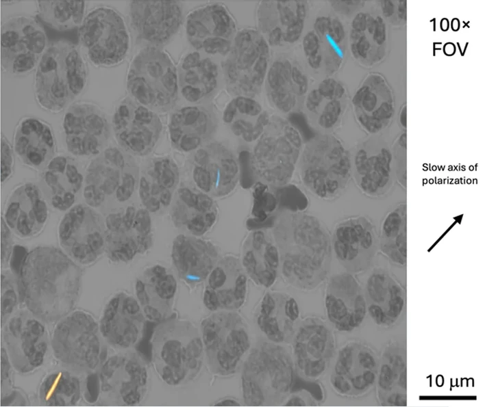 The locating view of a synovial fluid field with monosodium urate needles among neutrophils, and an arrow beside it marking the slow axis of the compensator.