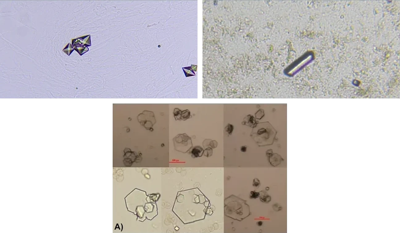 Three unlabeled urine sediment photomicrographs, two above and one below.